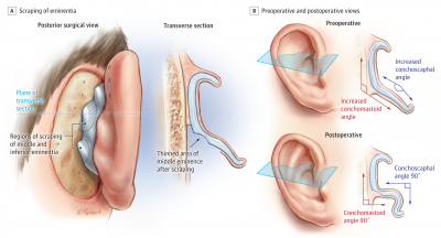 Otoplasty procedure